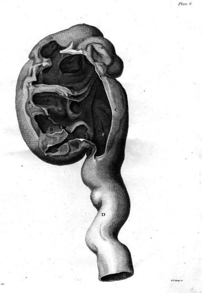 File:Hunter enlarged kidney.jpg