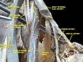 Lumbosacral plexus Deep dissection.