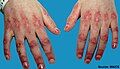 Dermatomyositis