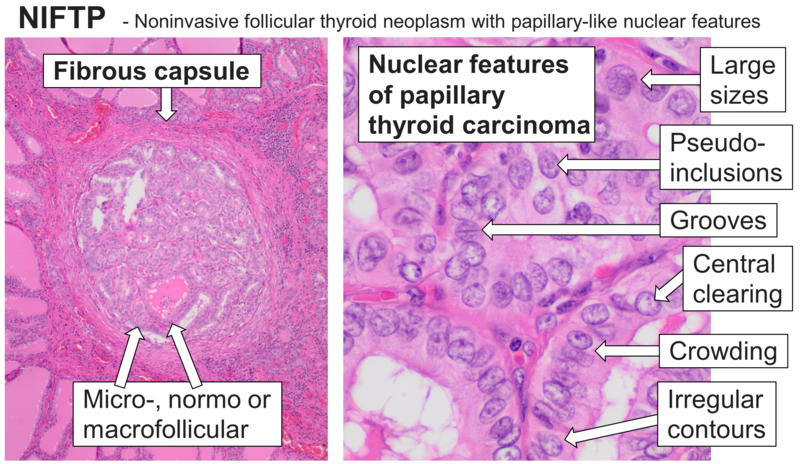 File:Histopathology of NIFTP.png