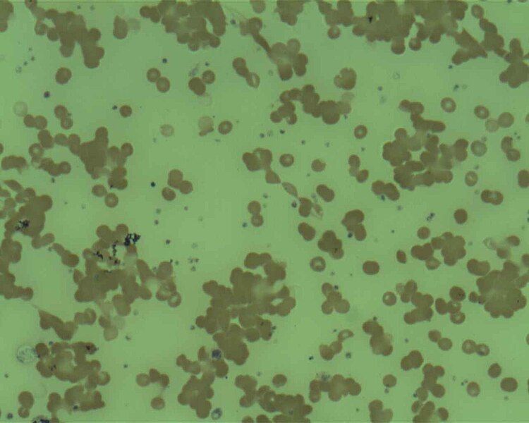 File:Red cell agglutination.jpg