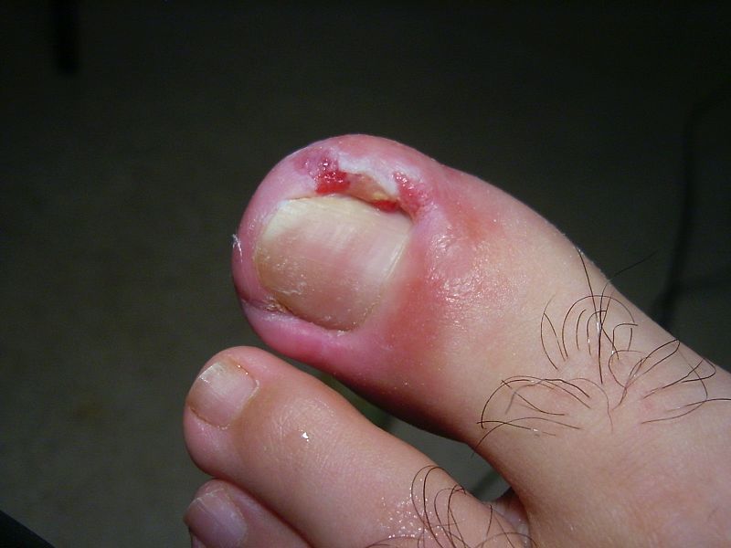 File:Toe (5).JPG