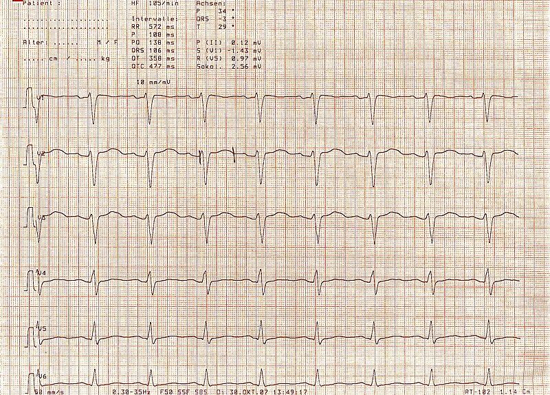 File:ECG long-QT bionerd.jpg