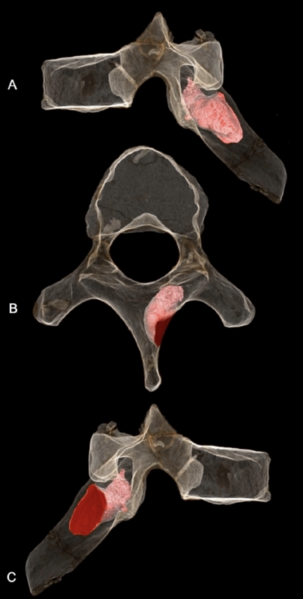 File:MH1 lesion.png