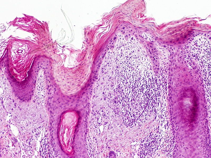 File:SkinTumors-P5280060.JPG