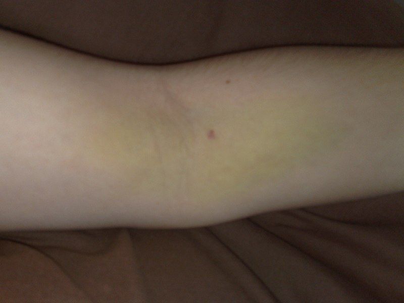 File:Blood donation bruising.jpg