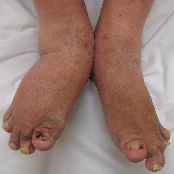 File:Psoriatic arthritis2010.JPG