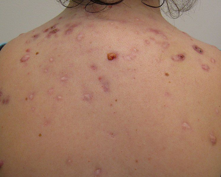 File:Backacne.JPG