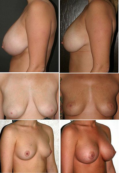 File:Breast Cosmetic Procedures.jpg