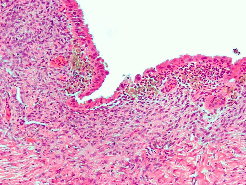 File:Endometrioma3.jpg