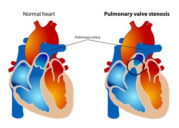 File:Pulmonary valve stenosis.svg