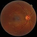 A fundus photograph showing the macula as a spot to the left. The optic disc is the area on the right where blood vessels converge. The grey, more diffuse spot in the centre is a shadow artifact.