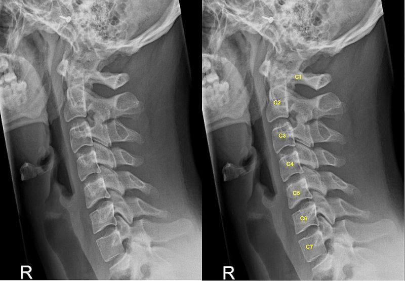 File:C-spine lat..JPG