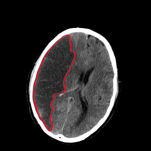 File:Infarction.svg