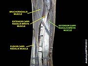 Extensor carpi radialis brevis muscle