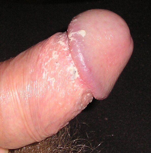 File:Smegma Penis02.jpg