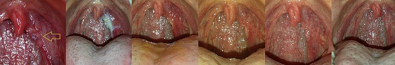 File:Wart Treatment Timeline.jpg