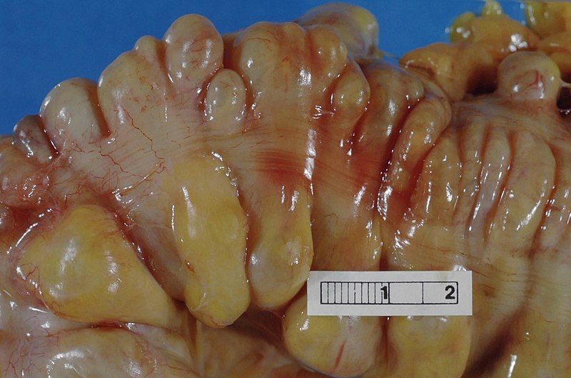 File:Diverticula, sigmoid colon.jpg