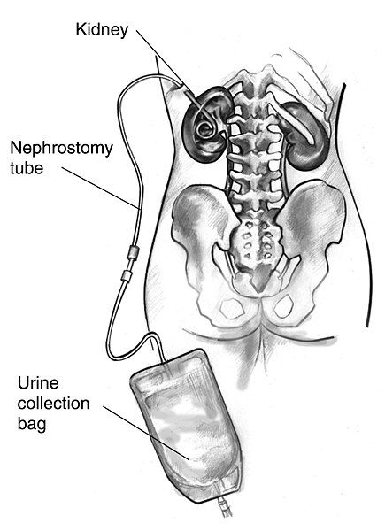 File:N01224 H nephrostomy.jpg