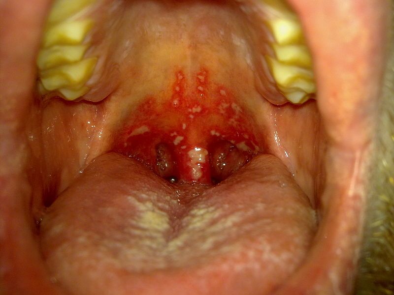 File:Stomatitis herpetica.jpg