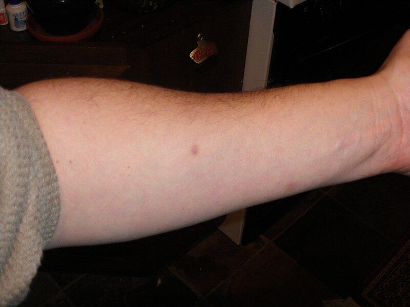 File:Negative Mantoux Test.jpg