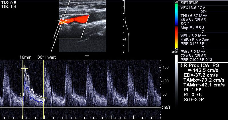 File:RICA Stenosis 174302500.jpg