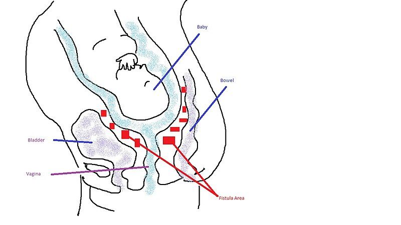 File:Obstetric Fistula Diagram.jpg