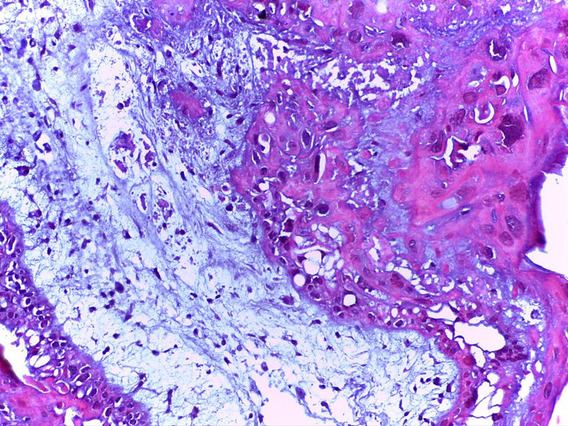 File:Vesicular Mole 20x.jpg