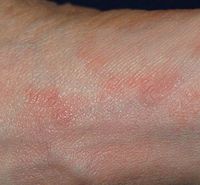 Scabies of the foot