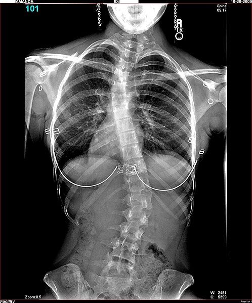 File:Amanda-Scoliosis.JPG