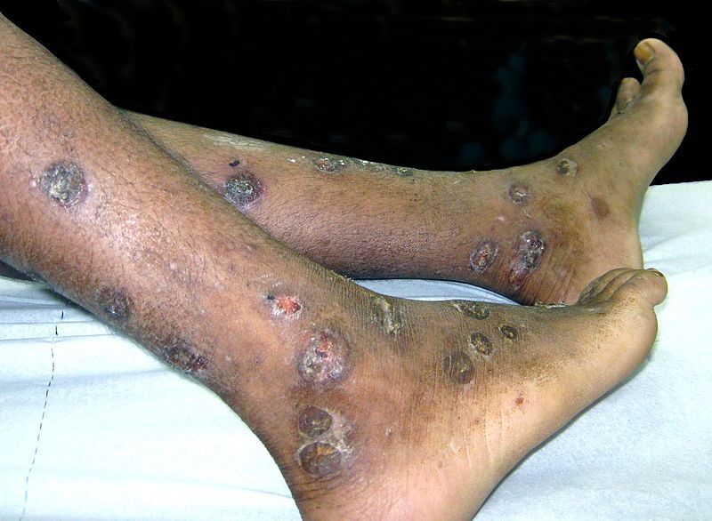 File:Impetigo crouteux jambes.jpg