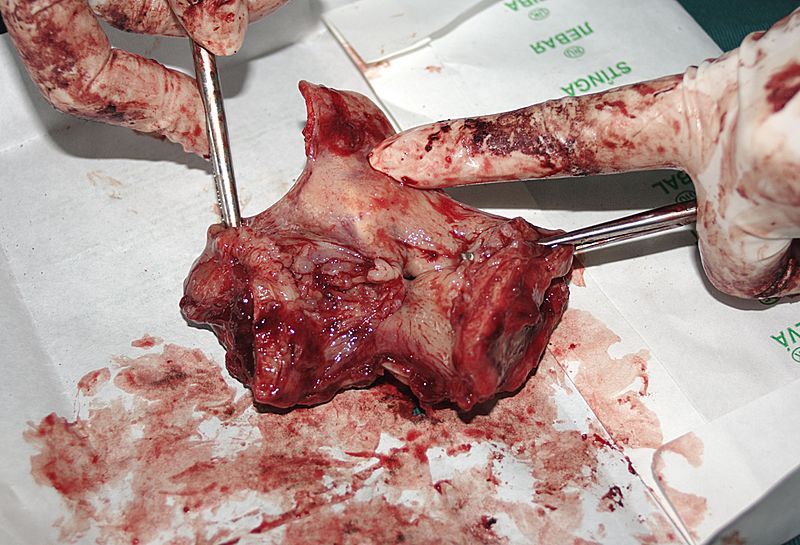 File:Larynx cancer 01.jpg