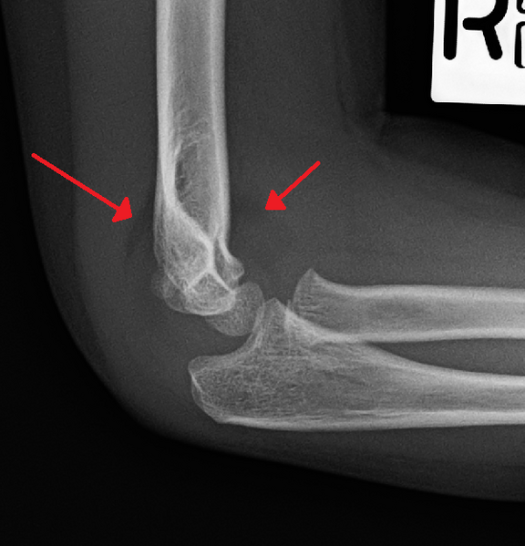 File:AnteriorandPSailSign.png