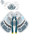 Weber's syndrome