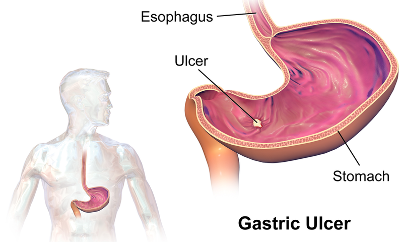 File:Gastric Ulcer.png