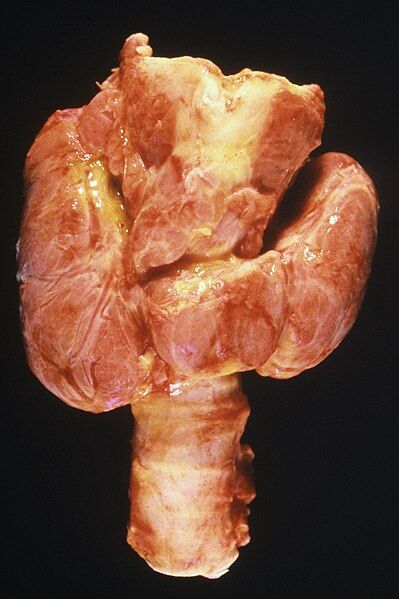 File:Thyroid, Diffuse Hyperplasia.jpg