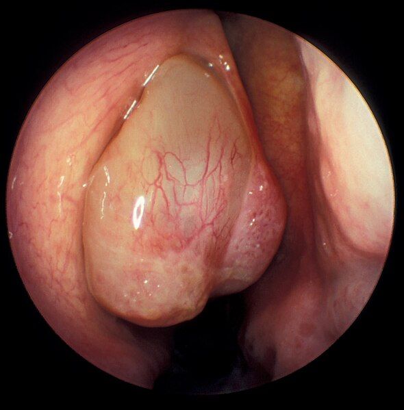 File:Middle meatus polyp.jpg