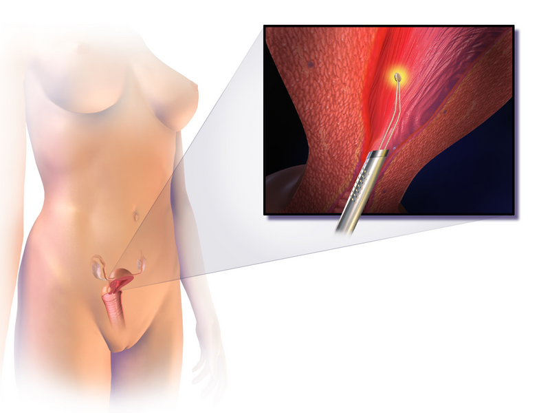 File:Endometrial Ablation.png