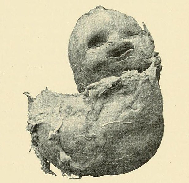 File:Lithopedion 1898.jpg