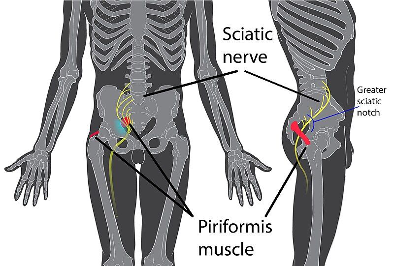 File:Piriformis syndrome.jpg