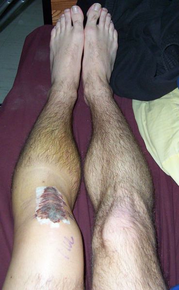 File:ACLReconstruction.jpg