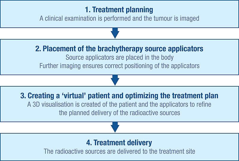 File:Brachytherapy procedure flow.jpg