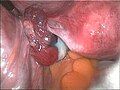 Dye visible in the fallopian tube