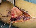 Intraoperative photo