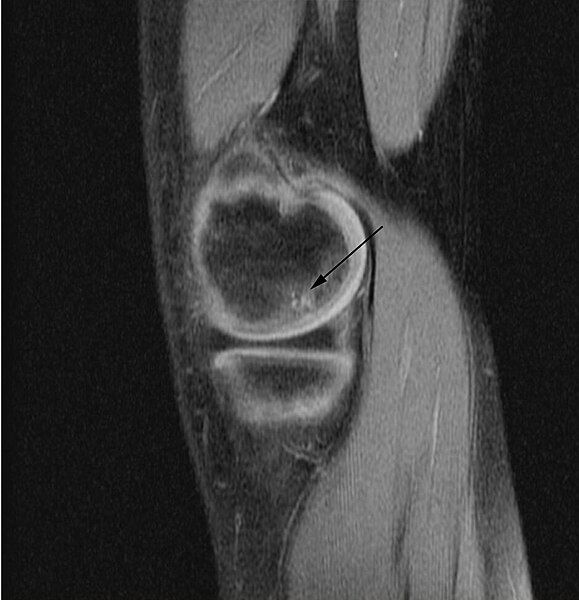 File:OCD WalterReed MRI-Sagital-T1.jpeg