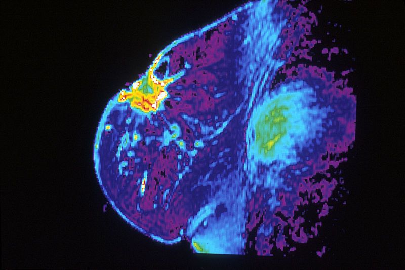 File:Mri of breast.jpg