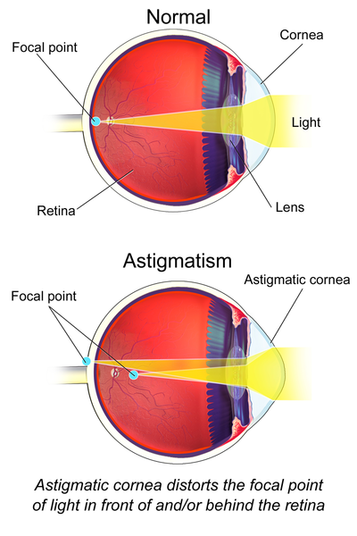 File:Astigmatism (Eye).png