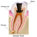 Blausen 0864 ToothDecay