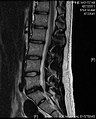 Example of a herniated disc at L5–S1 in the lumbar spine