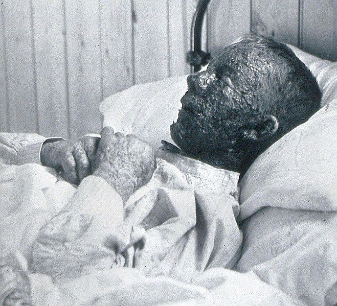 File:Malignant smallpox (cropped).jpg